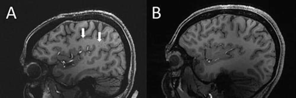 片頭痛を起こす人の脳内の急激な変化が初めてMRIで確認された